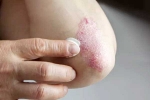 Skin disorders treatment, Skin disorders articles, five common skin disorders and their symptoms, Immune system