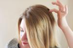 dandruff, hair loss., remedies to get rid of itchy scalp, Itchy scalp