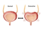 Overactive Bladder updates, Overactive Bladder, here are some warning signs of an overactive bladder, Bladder