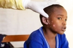 Monkeypox Outbreak latest, Monkeypox, is monkeypox outbreak coming to india, Monkeypox