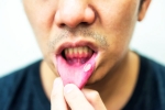 Mouth Ulcers symptoms, Mouth Ulcers medicines, mouth ulcers and home remedies, Healthy gut