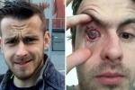 parasites in eyes, contact lenses in wate, contact lens wearers beware man goes blind after parasites eat man s eye as he wore lenses in shower, Cornea