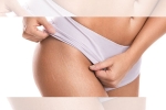 white stretch marks weight loss, white stretch marks before and after, difference between red and white stretch marks explained and it s natural to have them, Stretch marks