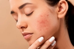 dermatologist, pimples, 10 ways to get rid of pimples at home, Dermatologist