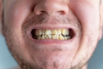 Nicotine stains good for health, Nicotine stains research, are nicotine stains on your teeth irreversible, Cigarette